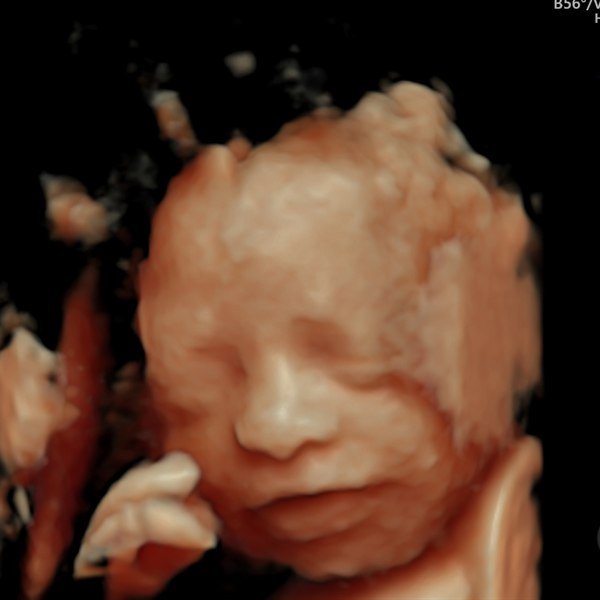 Ecografía de Eidan Daniel · rostro en 4D